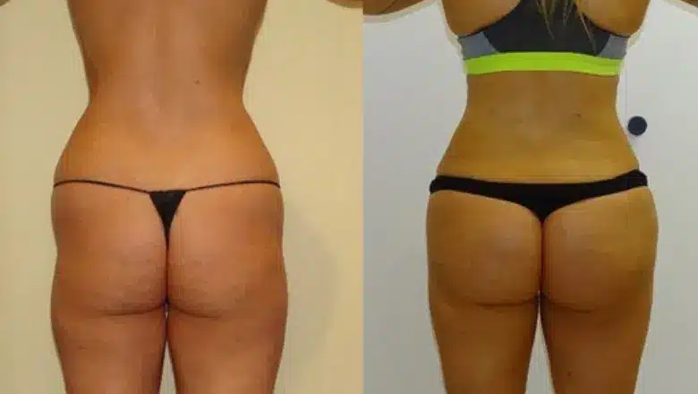 Brazilian butt lift (BBL) before and after, result 23