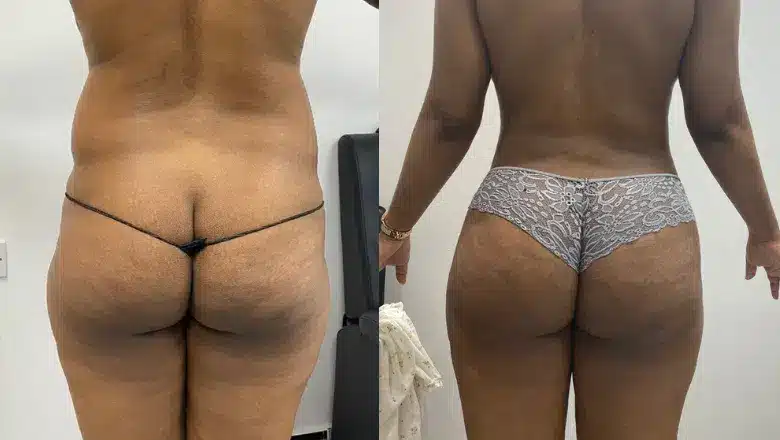 Brazilian butt lift (BBL) before and after, result 24