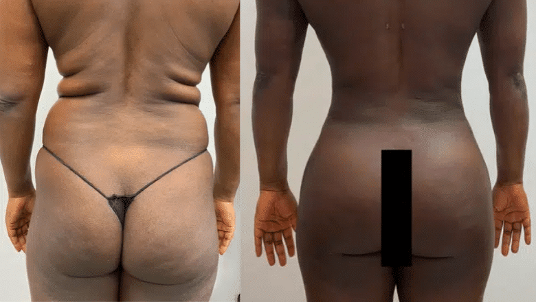 Brazilian butt lift (BBL) before and after, result 17