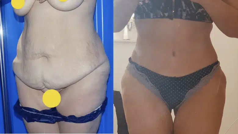 Tummy tuck before and after, result 1