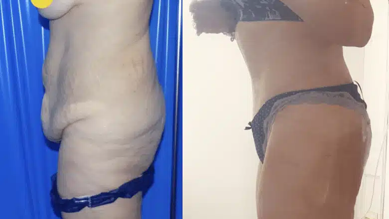Tummy tuck before and after, result 2