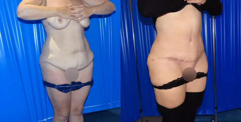 Tummy tuck before and after, result 27
