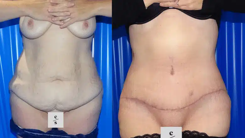Tummy tuck before and after, result 26