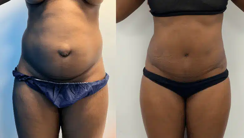 Tummy tuck before and after, result 25