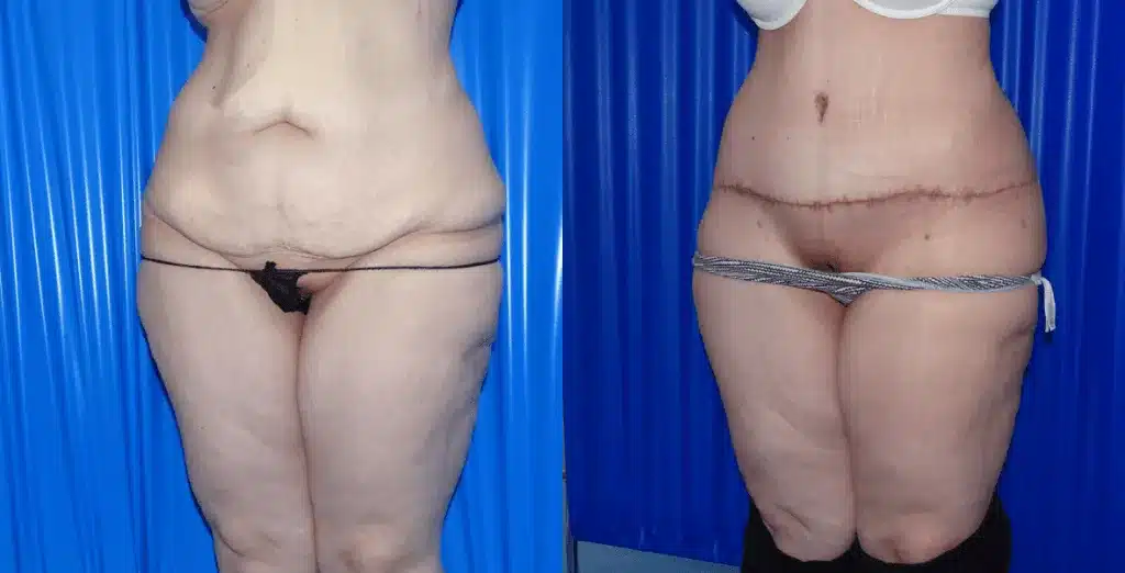 Tummy tuck before and after, result 54