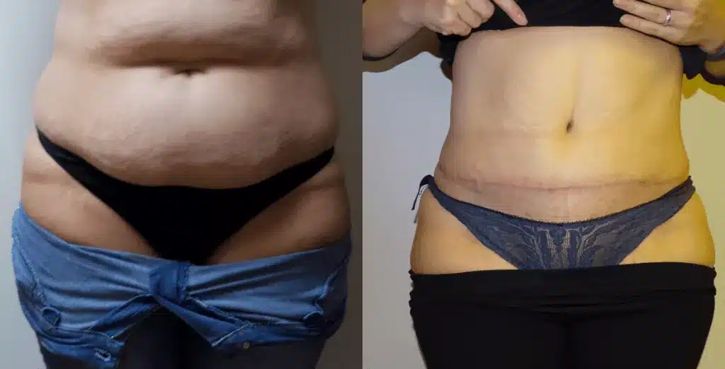 Tummy tuck before and after, result 55