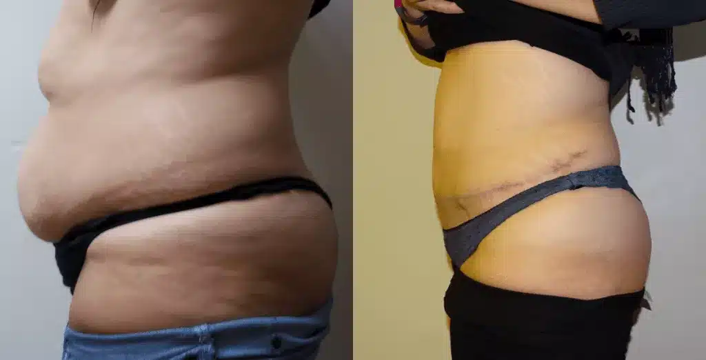 Tummy tuck before and after, result 56