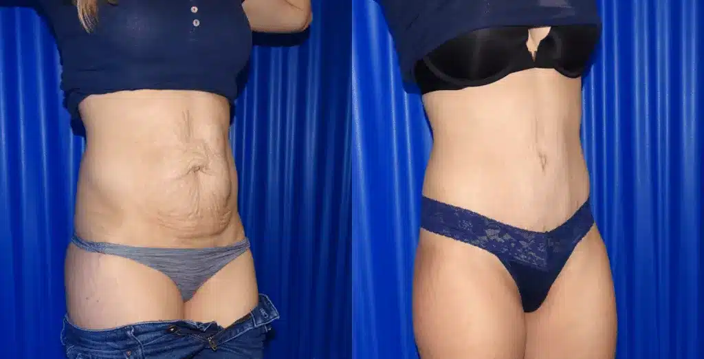 Tummy tuck before and after, result 63