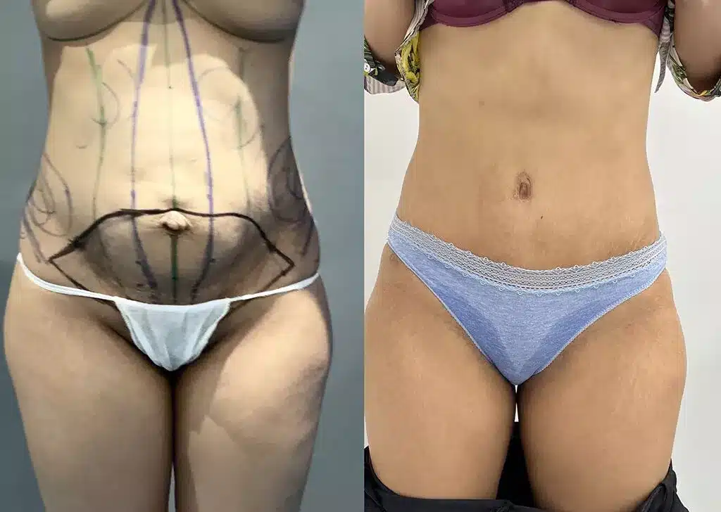 Tummy tuck before and after, result 65