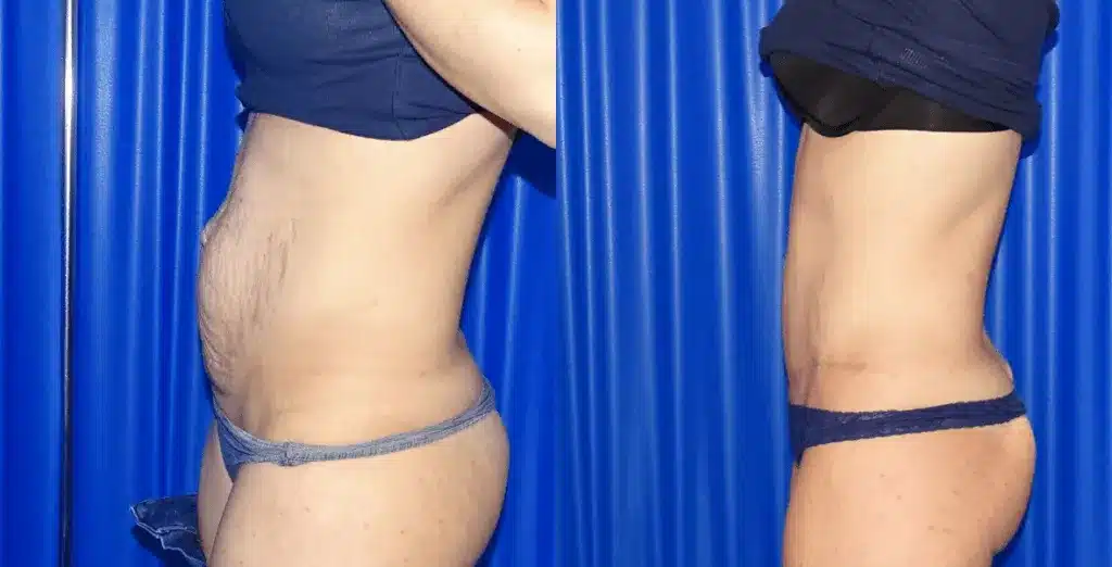 Tummy tuck before and after, result 64