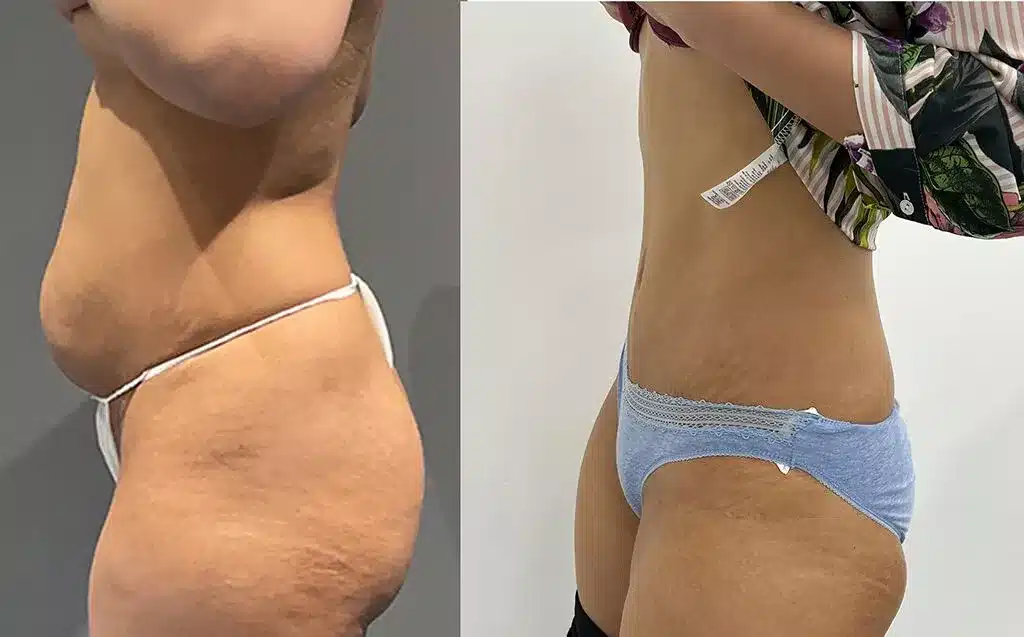 Tummy tuck before and after, result 67