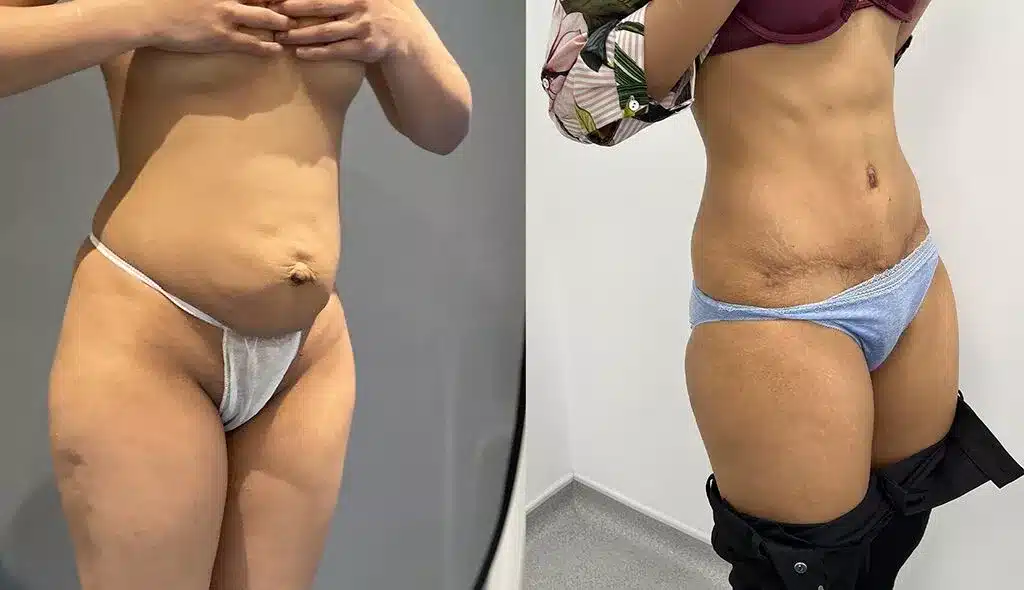 Tummy tuck before and after, result 66