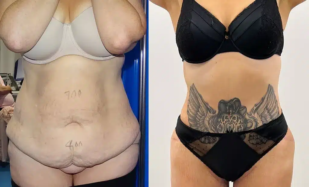 Tummy tuck before and after photos, front view