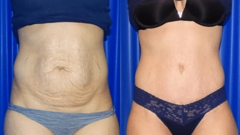 tummy tuck and hernia repair