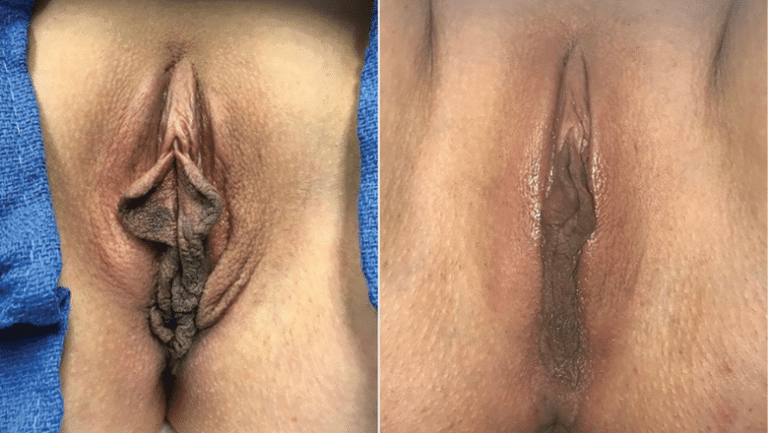Labaha Types Different Types of Labia Shapes | Centre for Surgery