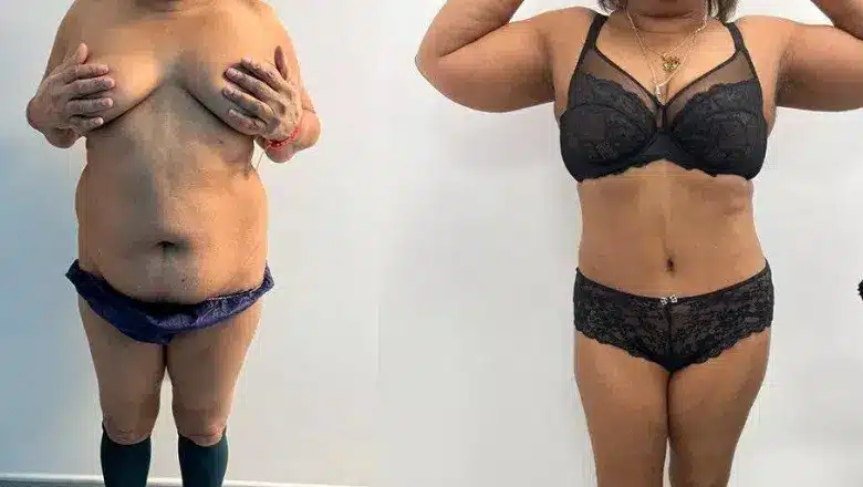 Liposuction before and after, result 13