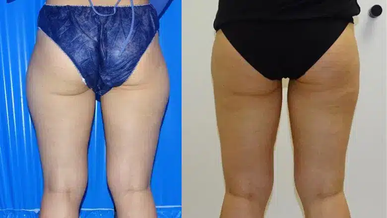 Liposuction before and after, result 24
