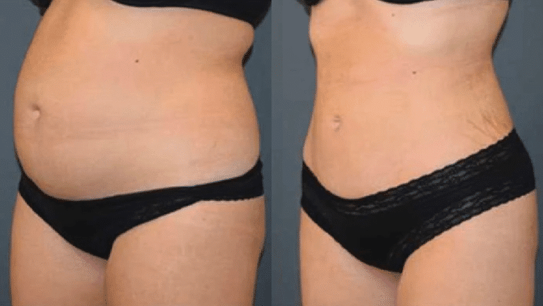 360 liposuction before and after photos, side view of the waist and abdomen