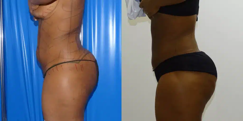 Liposuction before and after, result 10