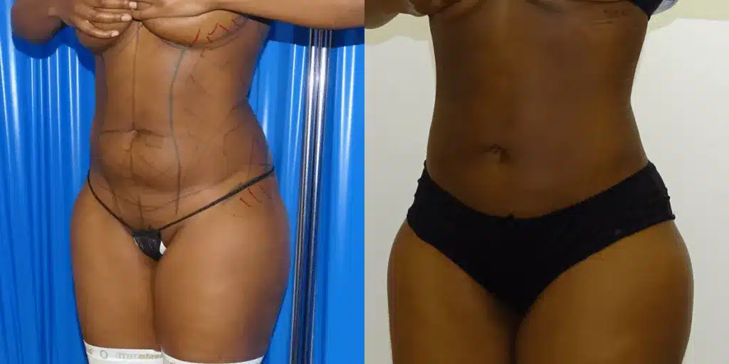 Liposuction before and after, result 9