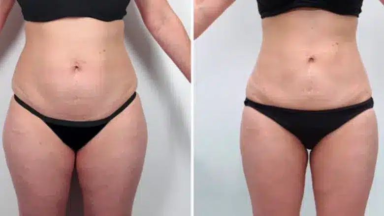 Liposuction before and after, result 12
