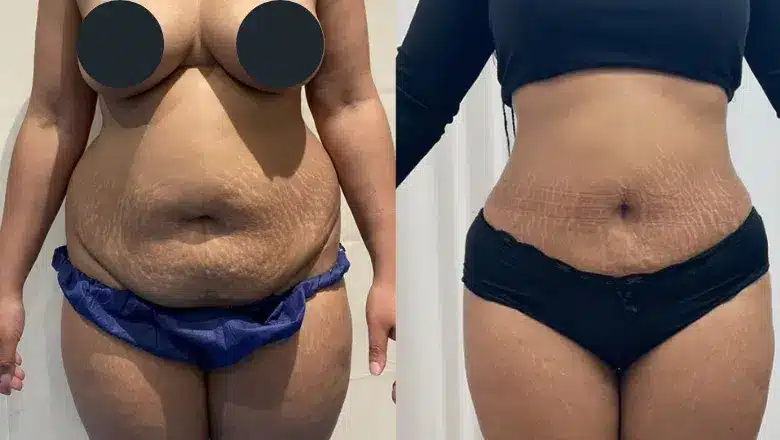 Liposuction before and after, result 2