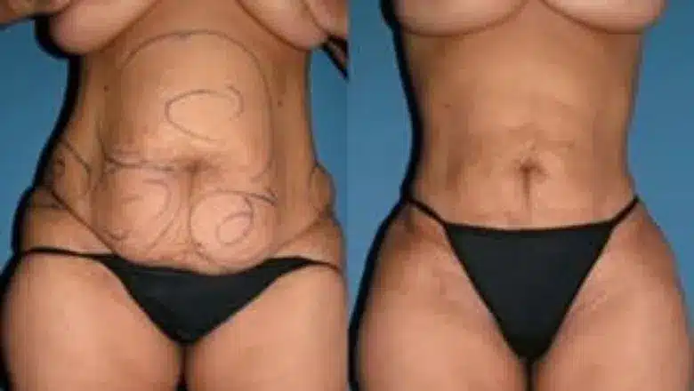 Liposuction before and after, result 1