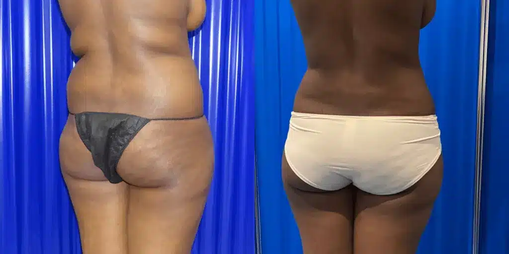 Liposuction before and after, result 6