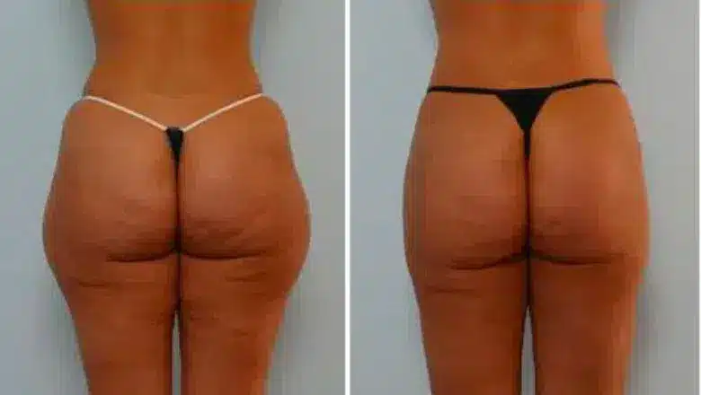 Liposuction before and after, result 25