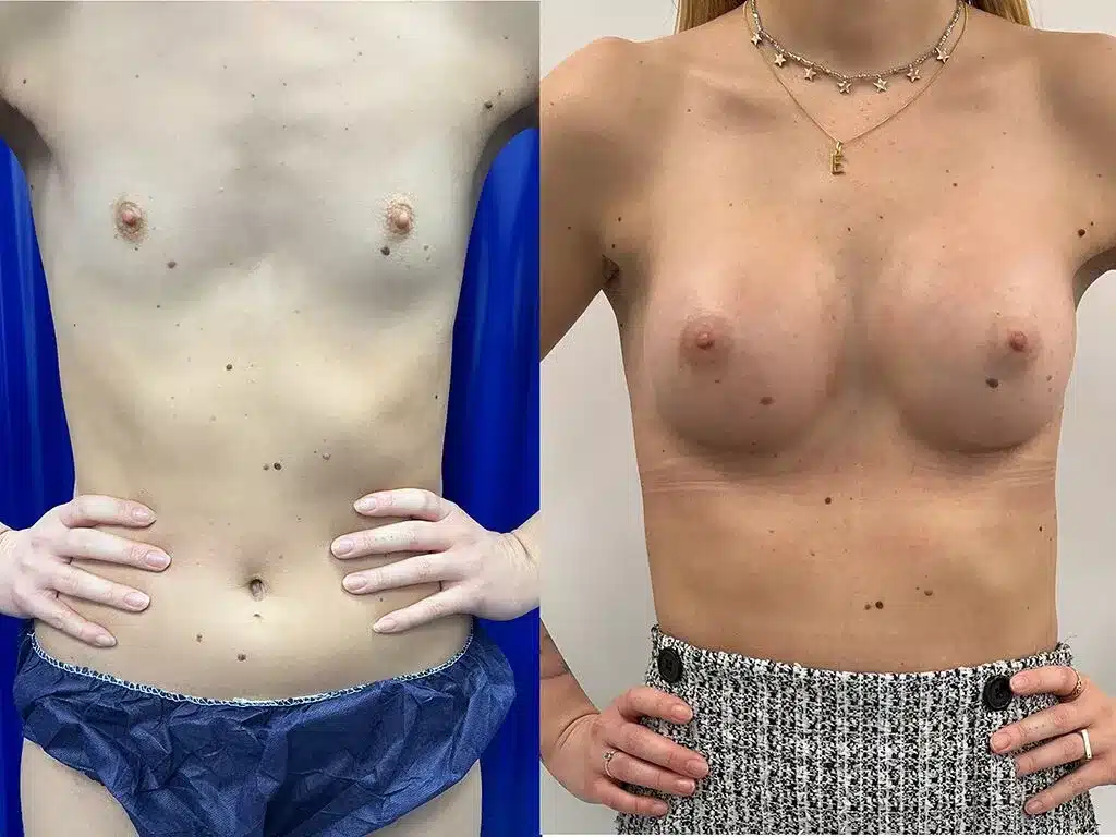 Breast augmentation before and after, result 30