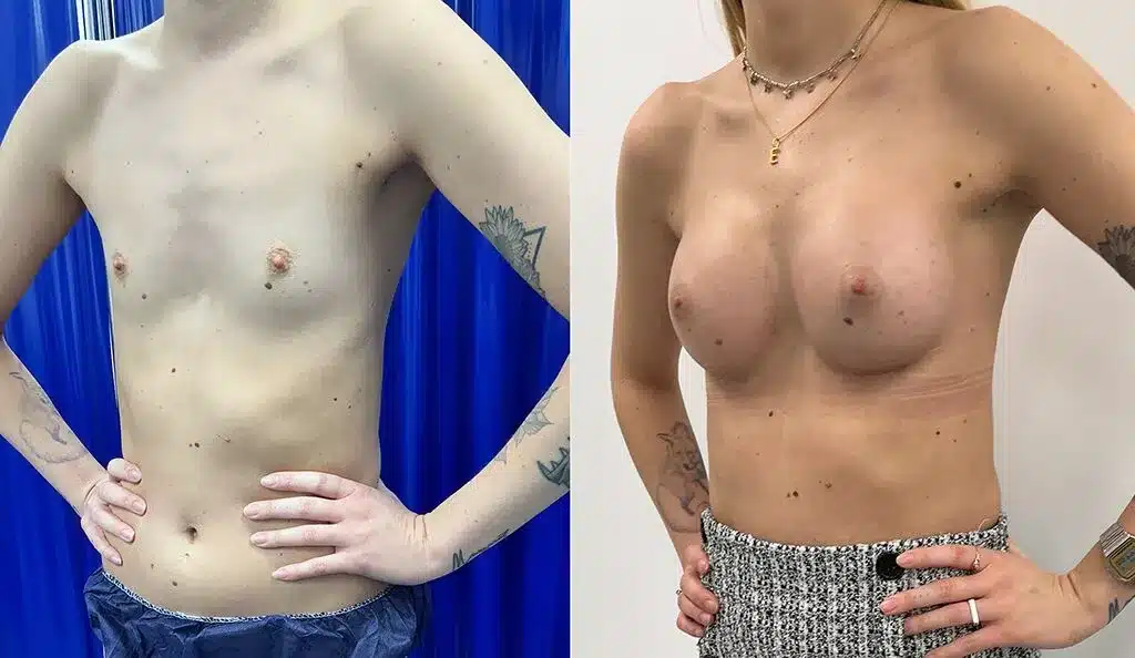 Breast augmentation before and after, result 31
