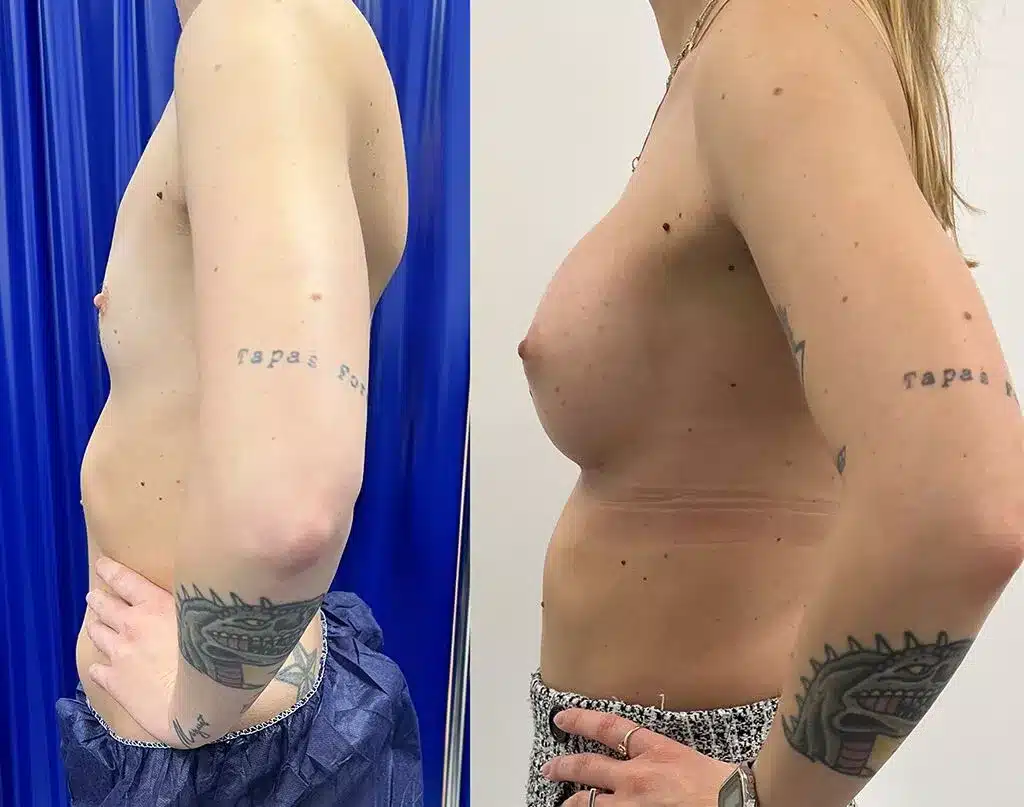 Breast augmentation before and after, result 32