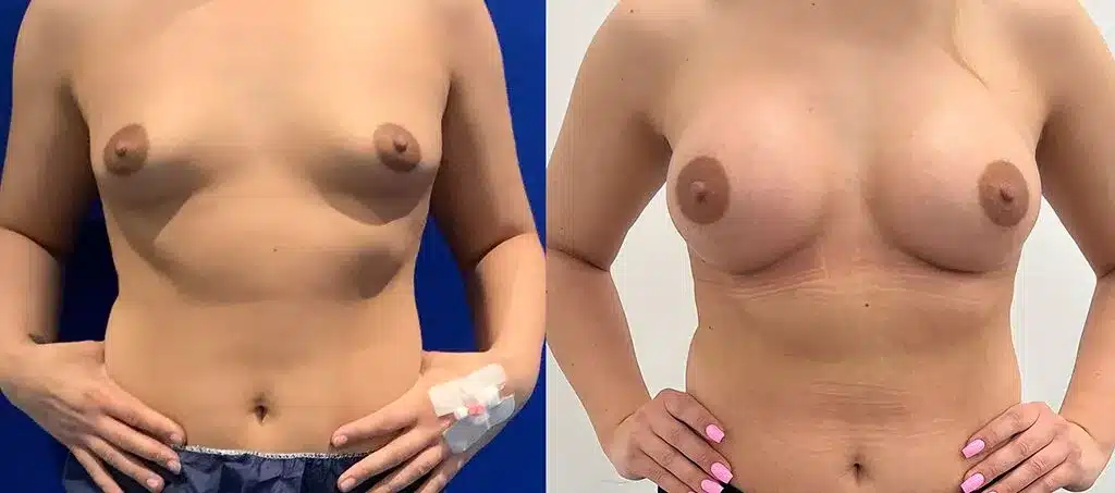 Breast augmentation before and after, result 25