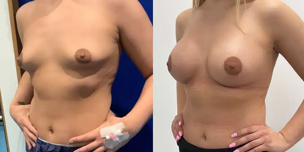 Breast augmentation before and after, result 26